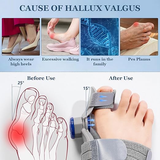 Bunion Corrector   مصحح انحراف إبهام القدم